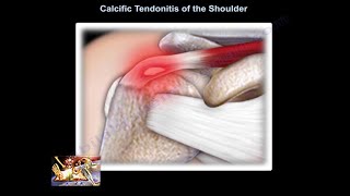 Calcific Tendonitis of the shoulder  Everything You Need To Know  Dr Nabil Ebraheim [upl. by Musette]