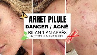 ARRET PILULE  DANGER ACNÉ Bilan un an après solutions naturelles conseils santé en danger [upl. by Amahs]