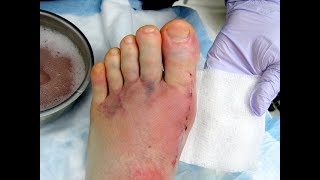 Bunion amp Hammer Toe Surgery Best PROVEN options [upl. by Ttennaej]