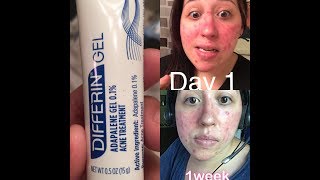 Differin gel acne treatment part 1 [upl. by Eednar]