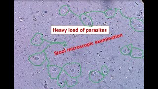 Heavy load of parasites in stool Stool microscopic examination Trichomonas hominis [upl. by Anesuza440]