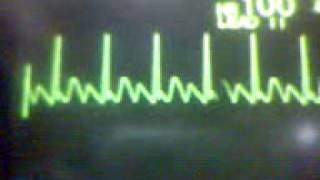 ECG Video Atrial Flutter [upl. by Anihsak224]