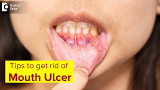 Mouth Ulcer Mouth Sores Symptoms Treatment amp Prevention MethodsDrLahari ASR  Doctors Circle [upl. by Corenda]