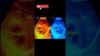 Liver hepatic pyogenic abscessultrasoundshorts [upl. by Newman798]