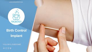 Birth Control Implant in Turkey 15 Minutes  Turk Aesthetic [upl. by Coh]