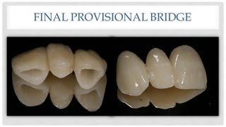 Dental Bridge The Esthetic Provisional Bridge [upl. by Anatole]