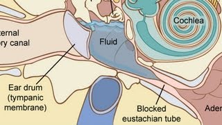 How to Treat Fluid in the Ear  Ear Problems [upl. by Eninahpets110]