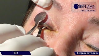 Stye removal procedure in the office [upl. by Arac]