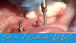 Placement of Mini Implants on Flat Ridge  Dental Minute with Steven T Cutbirth DDS [upl. by Lowrance372]