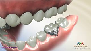 Orthodontic Band Placement on a Molar [upl. by Oicaroh]