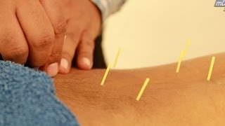 HINDI Acupuncture Treatment Demo [upl. by Mikah272]