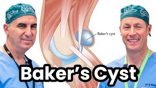 Understanding and Treating Bakers Cyst [upl. by Raual]