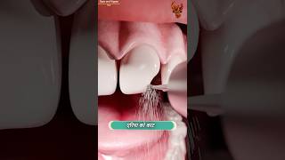 How teeth are fixed 😳 दांत कैसे ठीक होते हैं  shorts [upl. by Wasson]