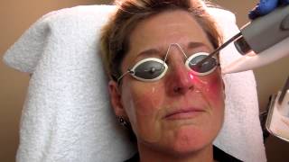 Nd YAG Laser Treatment for Rosacea at Total Body Care [upl. by Beauregard]