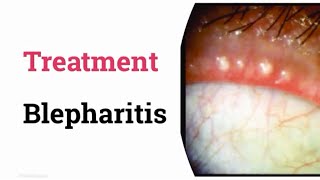 Treatment of Blepharitis [upl. by Ociredef]