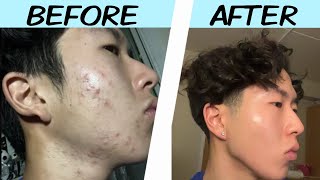 My Acne Journey Skincare Motivation [upl. by Hoenack]