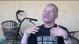 Burkina  Le combat des personnes albinos [upl. by Nefen200]