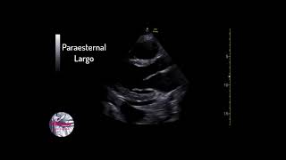 ¿Derrame pericardico o pleural [upl. by Anaeed]