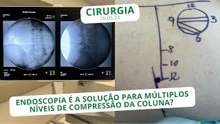 Endoscopia é a solução para múltiplos níveis de compressão da coluna  160524 [upl. by Sulokcin528]