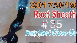 Hair Root  Root Sheath Close Up ＃35【Plucking Hair Root Sheath】 [upl. by Meris851]