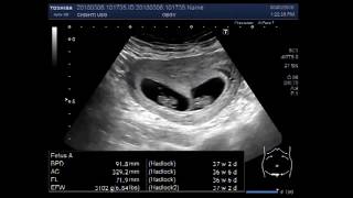 Ultrasound Video showing scan of an early twin pregnancy [upl. by Most916]