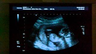 Identical twins 13 weeks ultrasound [upl. by Amora165]