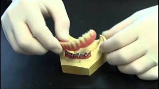 Prothese clipsee sur implant avec barre [upl. by Lodnar]