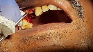 Extraction Of Upper Premolar Root Stumps Dr Sunil Kumar [upl. by Bezanson]