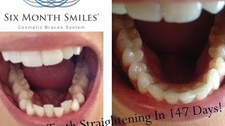 Six Month Smile Braces With Tracy Kiss [upl. by Buddy]