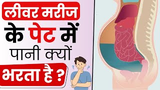 जलोदर Ascites क्या होता है  Ascites Causes Symptoms and Treatment  Bharat Homeopathy [upl. by Anabal]