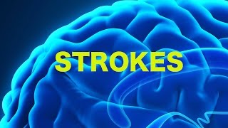 Strokes amp The Rule of 4s  USMLE [upl. by Ilarin952]