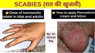 Scabies infection खाज treatment and Head lice जू treatment by Dr Nitesh Raj [upl. by Acinat]