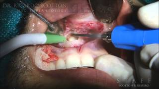 IMPACTED MESIODENS EXTRACTION [upl. by Killen]