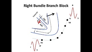 ECG course Bundle Branch Blocks Dr Sherif Altoukhy [upl. by Herrmann]