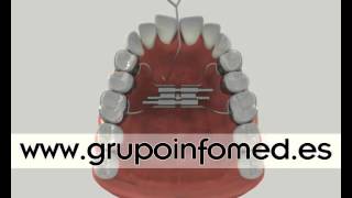 Didactic Software Dental  Expansor maxilar [upl. by Otsugua]