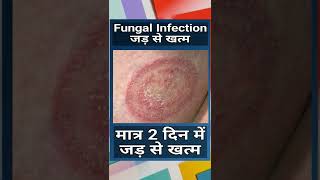 Fungal Infection Treatment  Fangal Infeksan In Skin  Fungal Infection Kaise Hota Hai [upl. by Yetac477]