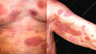 What is Mycosis Fungoides Symptoms Causes Treatment Diagnosis Cutaneous T Cell Lymphoma [upl. by Miche]