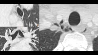 Traumatic pneumomediastinum  CT findings and basic diagnostic approach [upl. by Lielos]