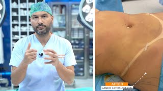 Laser Liposuction Procedure [upl. by Ainattirb278]