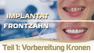 Implantat einsetzen Frontzahn Ablauf Teil 1  Vorbereitung für die Kronen und provisorische Brücke [upl. by Root]