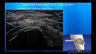 Ultrasound Guided Hip Greater Trochanteric Bursa Injection [upl. by Nera]