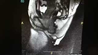 Magnetic Resonance Defecography Rectocele Cystocele [upl. by Itteb]