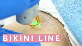 Laser Hair Removal Bikini THIS is how it works [upl. by Anikat226]