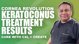 Keratoconus Treatment Results with CREATE Protocol and Crosslinking with Dr Motwani [upl. by Sirref]