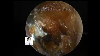 Reexamination of cholesteatoma of the external auditory canal 20220516 [upl. by Ekaterina]