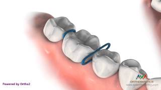 Orthodontic Separator or Spacer  Rubber ORings [upl. by Ttocserp]