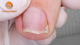 Flat feet and hallux valgus  Nail trimming and groove cleaning [upl. by Naesad]