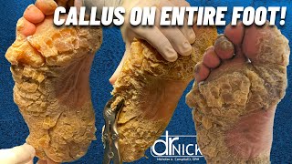 SHAVING CALLUS ON ENTIRE SOLE OF FOOT Dr Nick Campitelli Foot amp Ankle Surgeon [upl. by Adamsun]