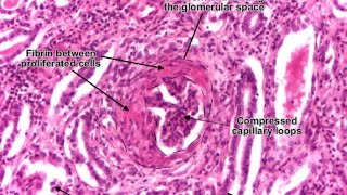 Rapidly Progressive Glomerulonephritis RPGN [upl. by Fionna]