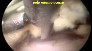 Vídeo Endoscopia de Coluna  Estenose de Canal Vertebral Lombar L45  Dr Marco Moscatelli [upl. by Yenalem797]